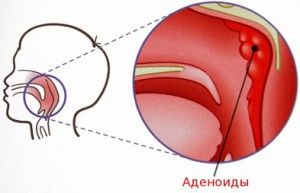 adenoids-300x193.jpg